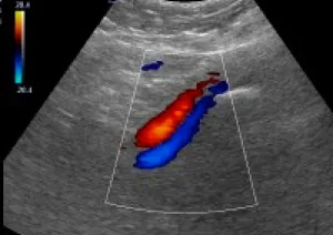 Так на екрані доплерівського апарату виглядає кровотік по артерії та вені.