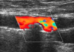 У просвіті артерії видно бляшку, що її звужує